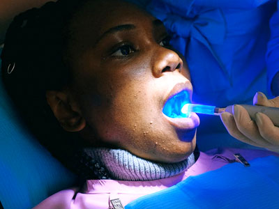 Teeth Whitening 